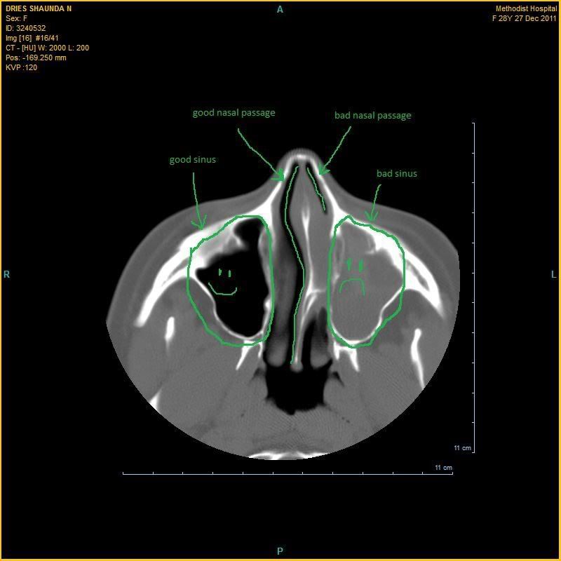 Ct+scan+sinus+infection