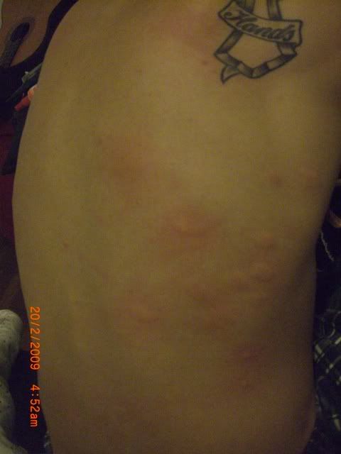 the bites he received whilst lying outside, except there was more on his bum LOL