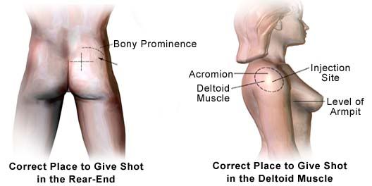 Steroid injection knee landmarks